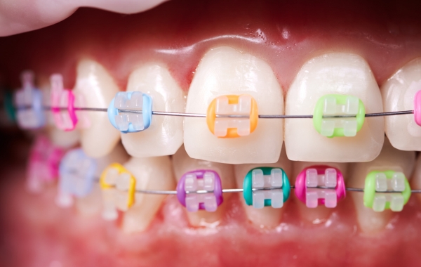 Ceramic Braces Treatment in Mumbai